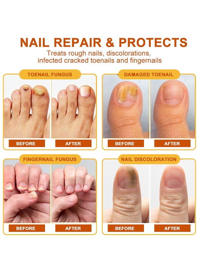 كريم سوميفون - كريم علاج فطريات الأظافر بسم النحل (الأصلي)