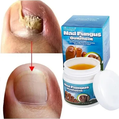 Sumifun - Nail Fungus Ointment (Original)