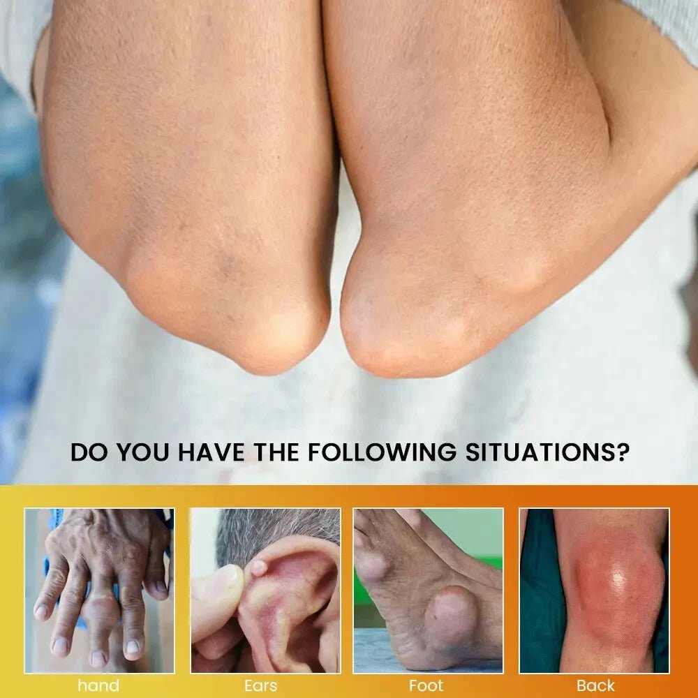 كريم سوميفون - لتخفيف أعراض النقرس (الأصلي)